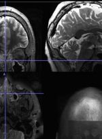 سینوزیت مزمن فعالیت مغز را تغییر می‌دهد